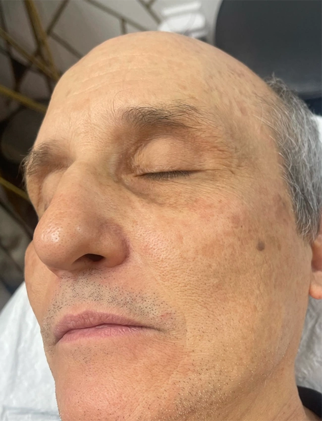 After VI Peel Treatment at Our Little Secret Aesthetics in Fort Myers, FL