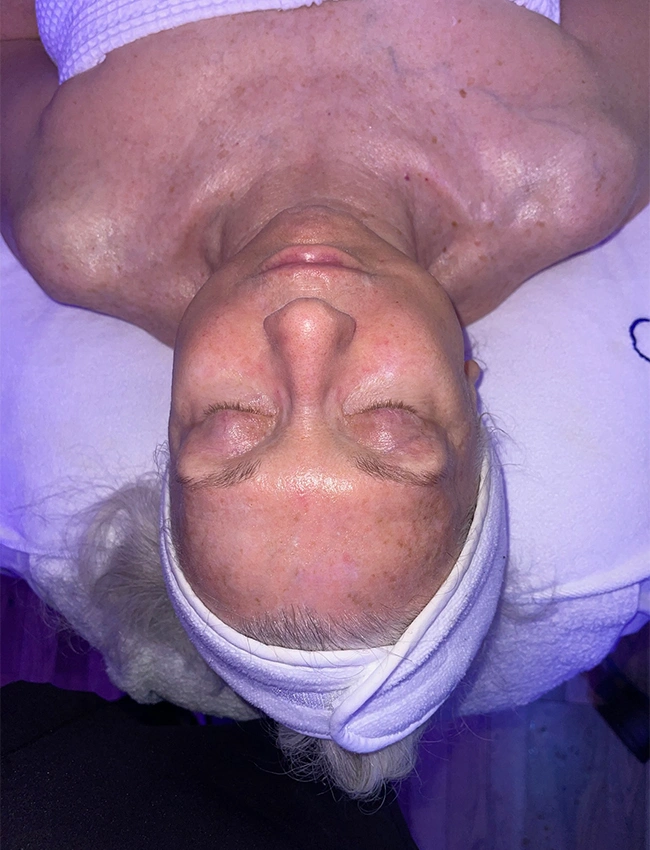 After Results of Hydrafacial Deeluxe at Our Little Secret Aesthetics in Fort Myers, FL