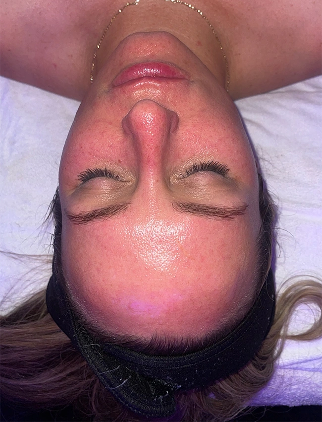 After Results of Hydrafacial Deeluxe at Our Little Secret Aesthetics in Fort Myers, FL