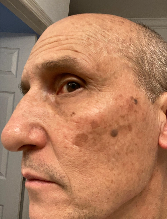 Before VI Peel Treatment at Our Little Secret Aesthetics in Fort Myers, FL