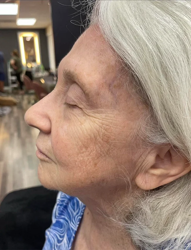 AFTER FACELIFT and Filler in gallery at Face Procedures at Our Little Secret Aesthetics in Fort Myers, FL