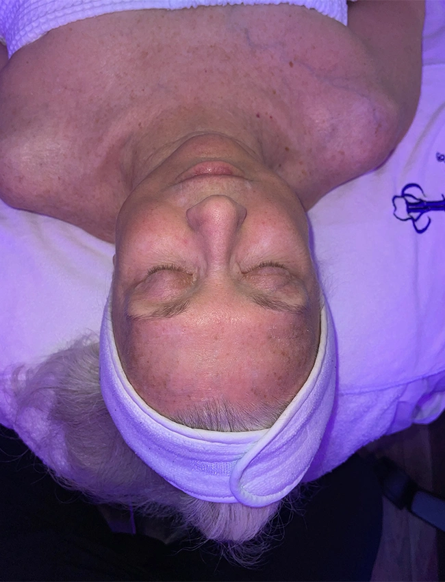 Before Hydrafacial Deluxe at Our Little Secret Aesthetics in Fort Myers, FL