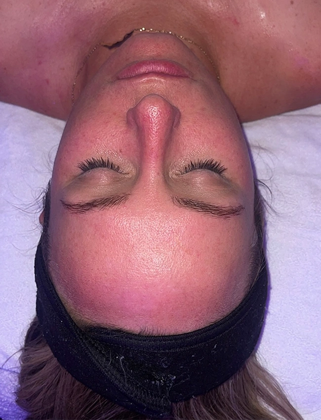 Before Hydrafacial Deluxe at Our Little Secret Aesthetics in Fort Myers, FL