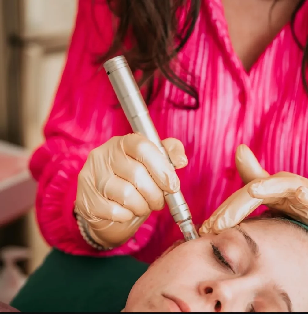 Microneedling Treatment at Our Little Secret Aesthetics in Fort Myers, FL