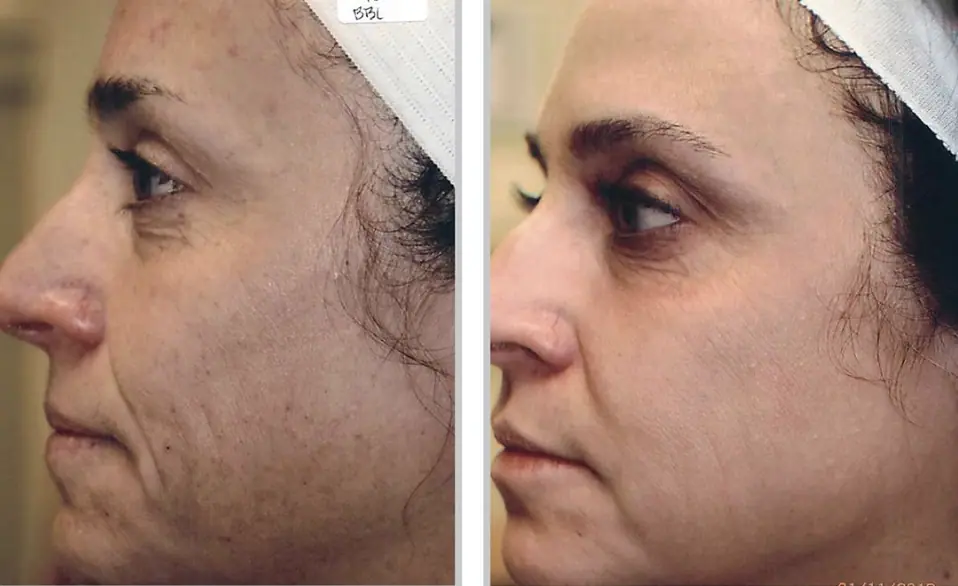 Before and After Results - BBL Forever Young BBL™ Treatment at Our Little Secret Aesthetics in Fort Myers, FL