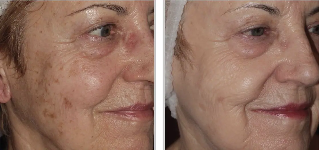 Before and After Results - BBL Forever Young BBL™ Treatment at Our Little Secret Aesthetics in Fort Myers, FL