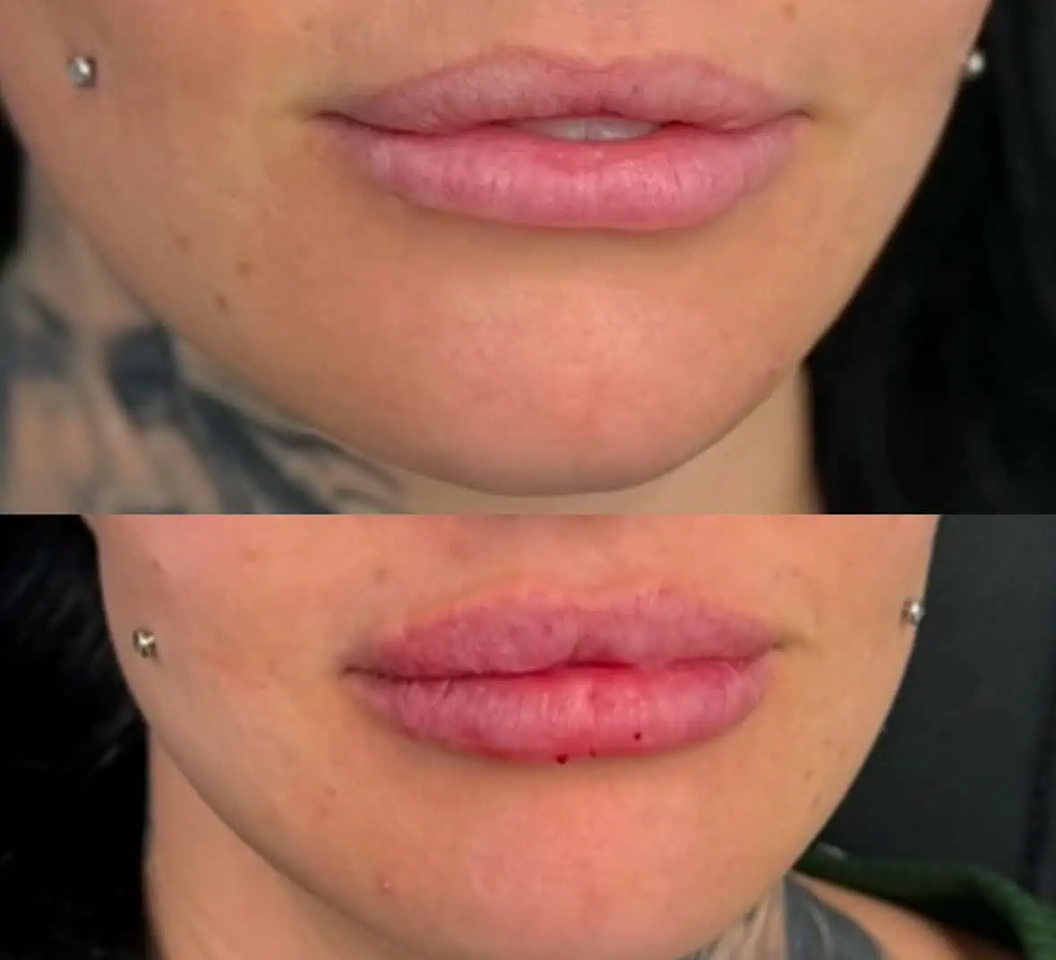 Lip Filler Treatment at Our Little Secret Aesthetics in Fort Myers, FL