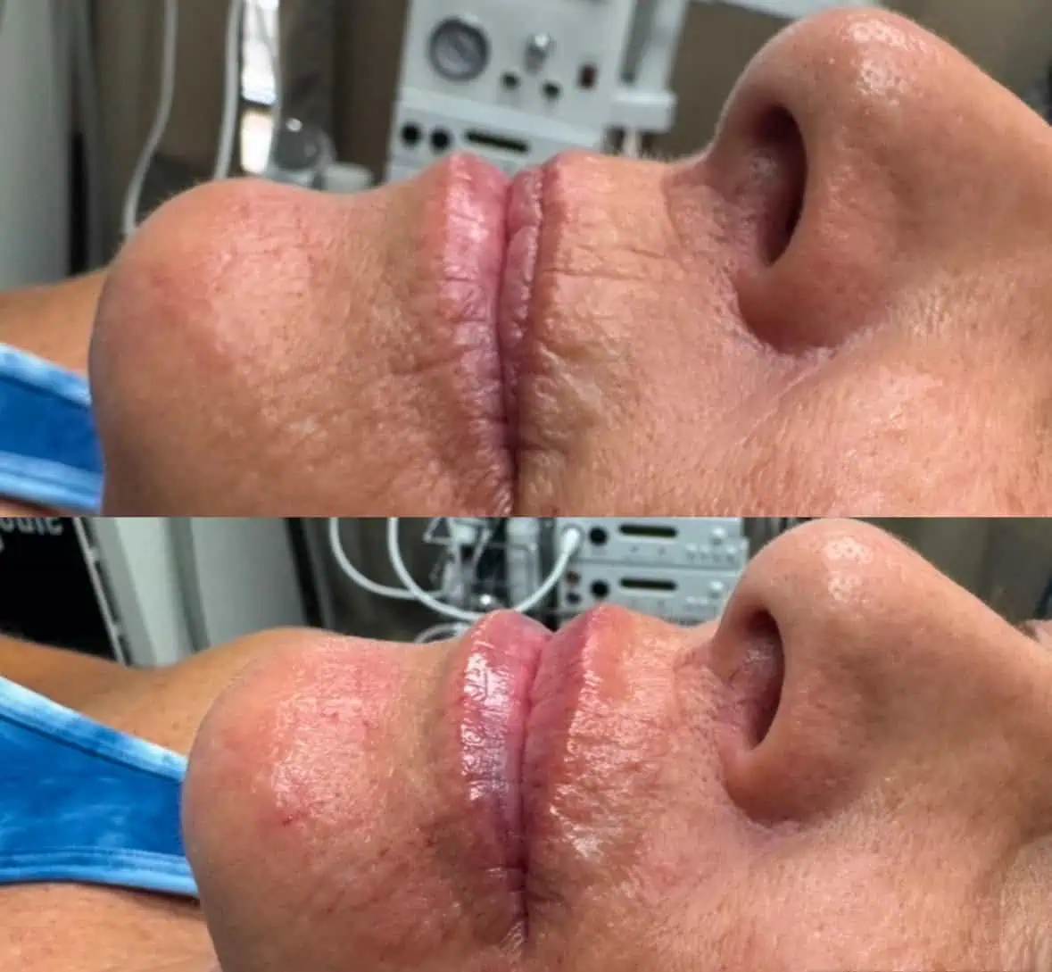 Lip Filler Treatment at Our Little Secret Aesthetics in Fort Myers, FL