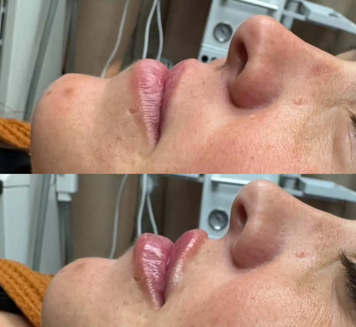 Lip Filler Treatment at Our Little Secret Aesthetics in Fort Myers, FL