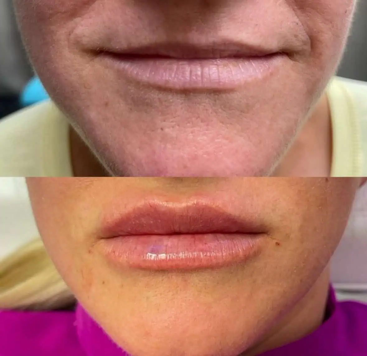 Lip Filler Treatment at Our Little Secret Aesthetics in Fort Myers, FL