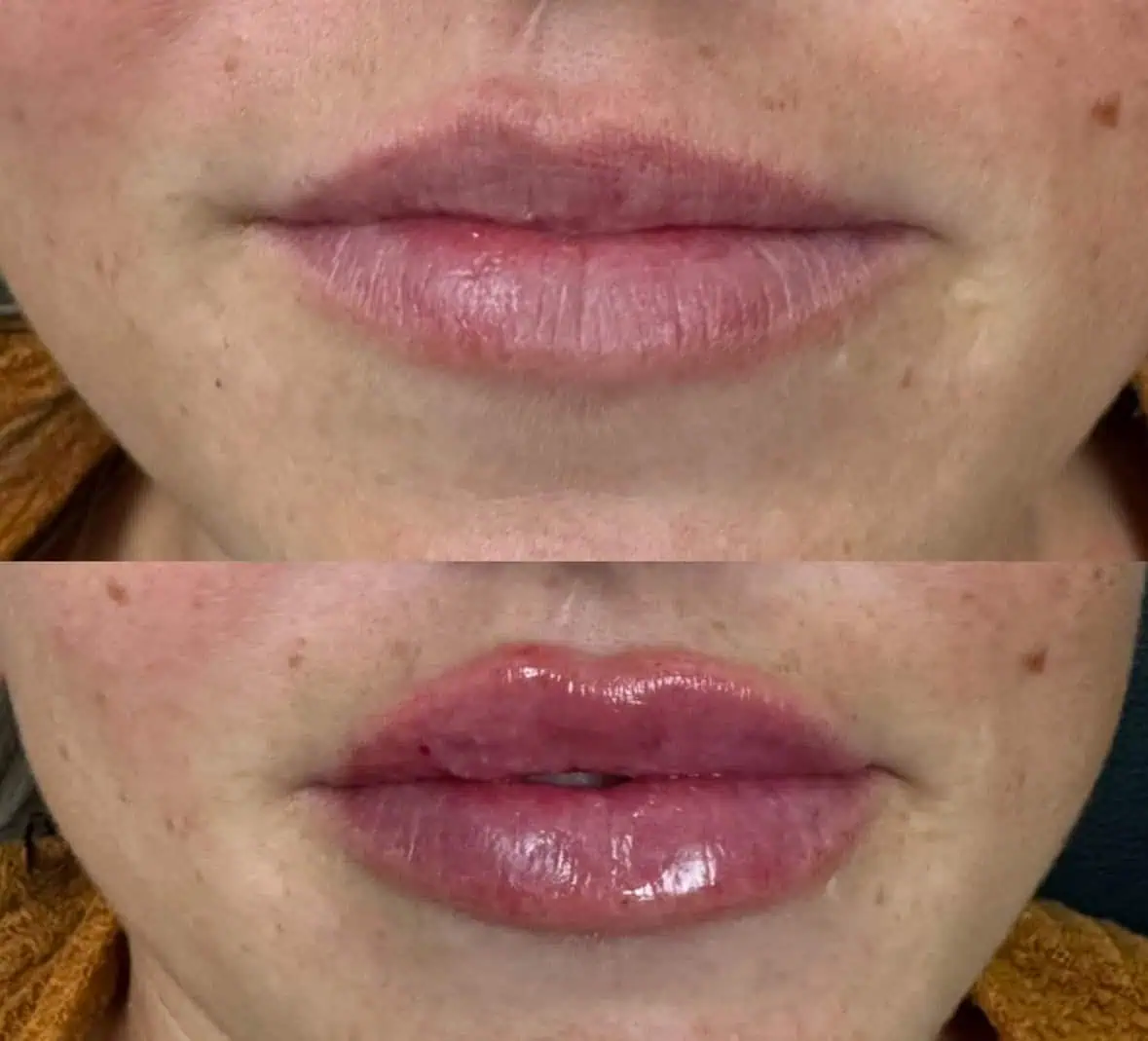 Lip Filler Treatment at Our Little Secret Aesthetics in Fort Myers, FL