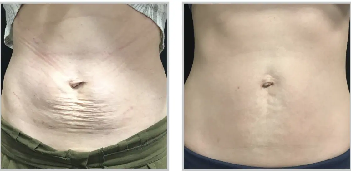 Sciton SkinTyte™ Treatment at Our Little Secret Aesthetics in Fort Myers, FL